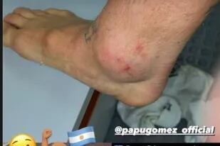 El posteo de Instagram en el que se ve cómo quedó el tobillo de Alejandro "Papu" Gómez tras el partido con Chile por la eliminatoria para Qatar 2022.