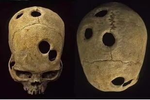Los incas practicaban la trepanación, un procedimiento quirúrgico en el que hacían un agujero en el cráneo de una persona viva con un instrumento afilado