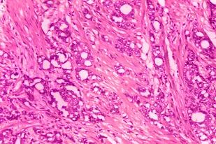 ARCHIVO - Esta imagen tomada con microscopio y facilitada por los Centros para el Control y la Prevención de las Enfermedades muestra cambios en las células, en un indicio de adenocarcinoma en una próstata. (Dr. Edwin P. Ewing, Jr./CDC vía AP)