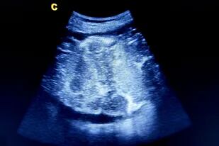 Imagen de ultrasonido de la placenta