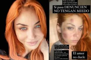 Lourdes Fernández, de Bandana, acusó a su expareja de golpearla