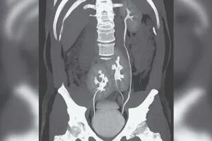 En las imágenes se ve el riñón izquierdo con apariencia normal y en el lugar del derecho hay dos órganos fusionados
