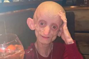 Ashanti padecía una enfermedad llamada progeria, conocida popularmente como la enfermedad de Benjamín Button
