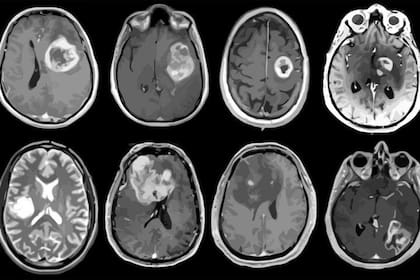 10-02-2021 Glioblastoma, tumor cerebral agresivo mapeado en detalle genético y molecular. SALUD ALBERT H. KIM