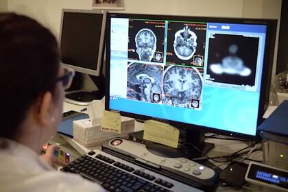 18/04/2024 Detectan con un análisis de sangre un mecanismo clave en el desarrollo del Alzheimer. La Fundación Centro de Investigación de Enfermedades Neurológicas (CIEN), dependiente del Instituto de Salud Carlos III y respaldada por la Fundación Reina Sofía, avanza en el diagnóstico preciso del Alzheimer mediante biomarcadores sanguíneos y ha confirmado la conexión entre los niveles en sangre de la proteína fibrilar glial ácida (GFAP, por sus siglas en inglés) y el desarrollo de la enfermedad, estableciendo por primera vez en humanos la relación entre esta proteína y la activación de los astrocitos en el cerebro, clave en los procesos inflamatorios de la patología. SALUD CIEN