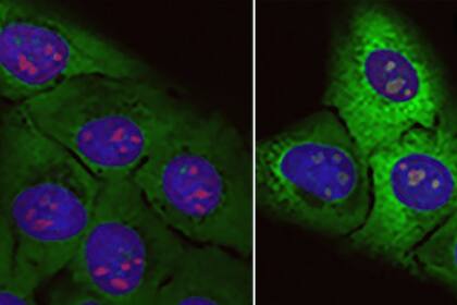 22/03/2024 Acumulación de “proteínas basura”: Células normales (izquierda) y células sometidas al efecto de la proteína tóxica rica en arginina (derecha). En esta se incrementan las proteínas ribosomales (verde fluorescente) y el tamaño de los nucléolos (rojo). SALUD CNIO