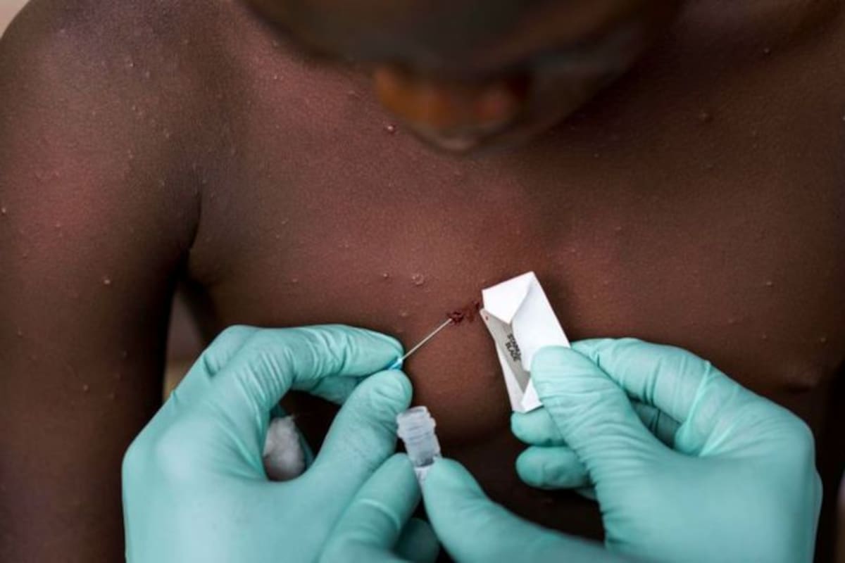 A diferencia de cuando se reportaron los primeros casos de coronavirus, la viruela del mono es una enfermedad ya conocida