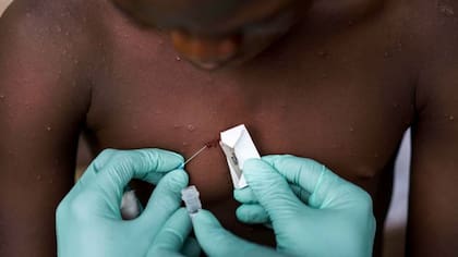 A diferencia de cuando se reportaron los primeros casos de coronavirus, la viruela del mono es una enfermedad ya conocida