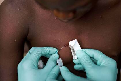 A diferencia de cuando se reportaron los primeros casos de coronavirus, la viruela del mono es una enfermedad ya conocida
