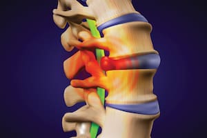 A herniated disc. Also called bulged, slipped or ruptured. Vector illustration.