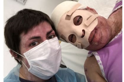 A Noelia le gusta visitar a otros quemados como una manera de ayudarlos a salir adelante
