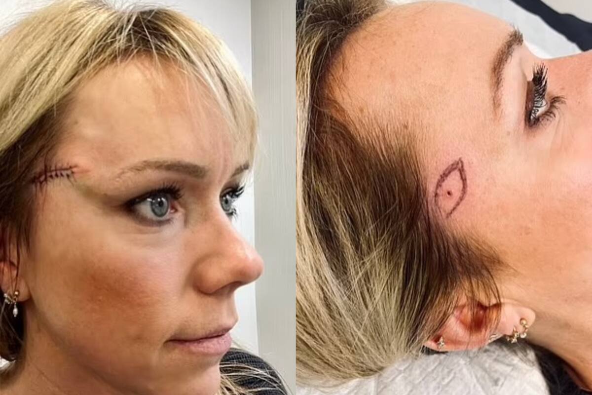 A Sarah le dijeron que tenía un tipo de cáncer común en la piel