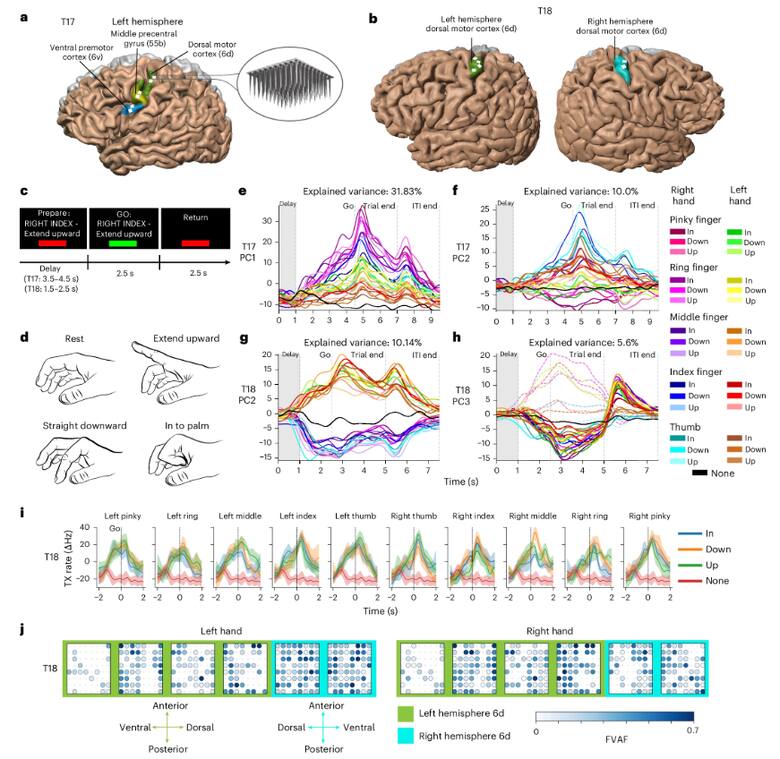 Imagen de BrainGate sobre dos personas con parálisis que pudieron teclear mediante electrodos conectados al cerebro.