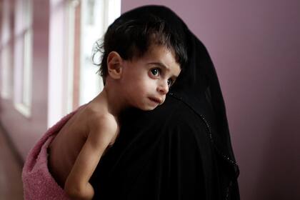 A woman holds her malnourished boy after he was weighed at a hospital malnutrition intensive care unit in Sanaa, Yemen