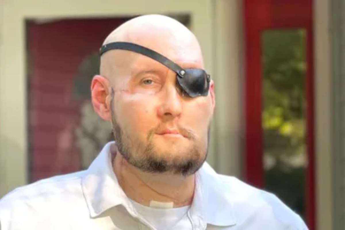 Aaron James fue trasplantado de un ojo