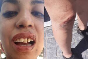 Abril subió a las redes sociales las heridas que le causó el codazo del policía