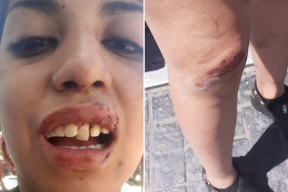 Abril subió a las redes sociales las heridas que le causó el codazo del policía