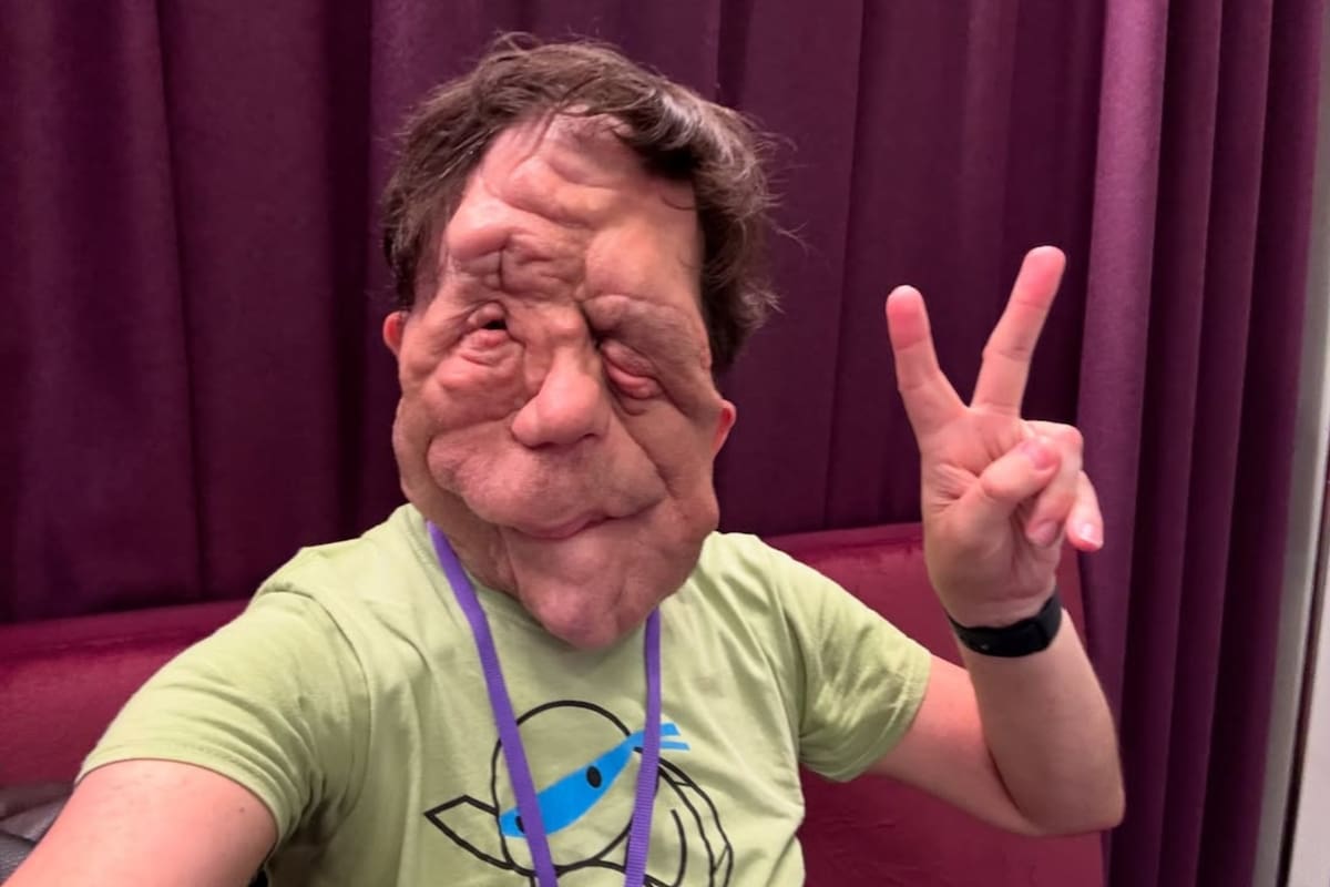Adam Pearson, el actor que dio que hablar en la ceremonia de los Oscar 2026 por su historia de superación y resiliencia