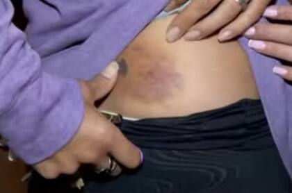 Una de las consecuencias del impacto del vehículo sobre el cuerpo de Adriana.