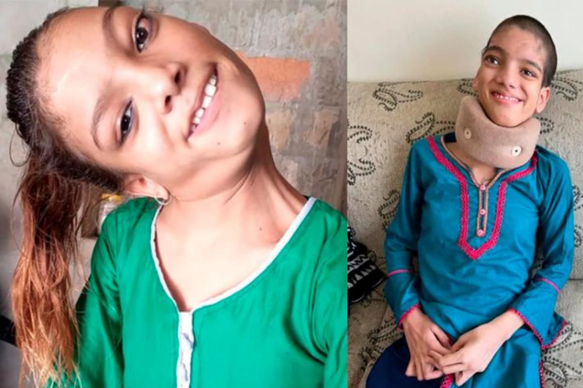 Afsheen Gul, la niña que vivió con su cuello rotado 13 años