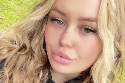 Ahora hace campaña contra el relleno de labios