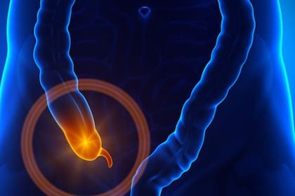 Al igual que ocurre con las muelas del juicio, a veces el apéndices genera molestias y tiene que extirparse.