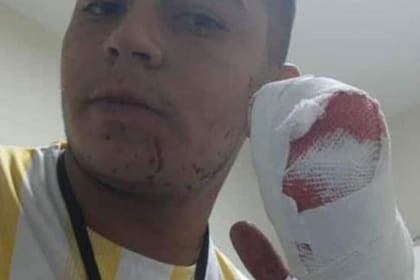 Al joven trabajador le cortaron cuatro dedos de su mano izquierda para robarle la moto