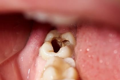 Las caries se originan a partir de la bacteria “streptococcus mutans”