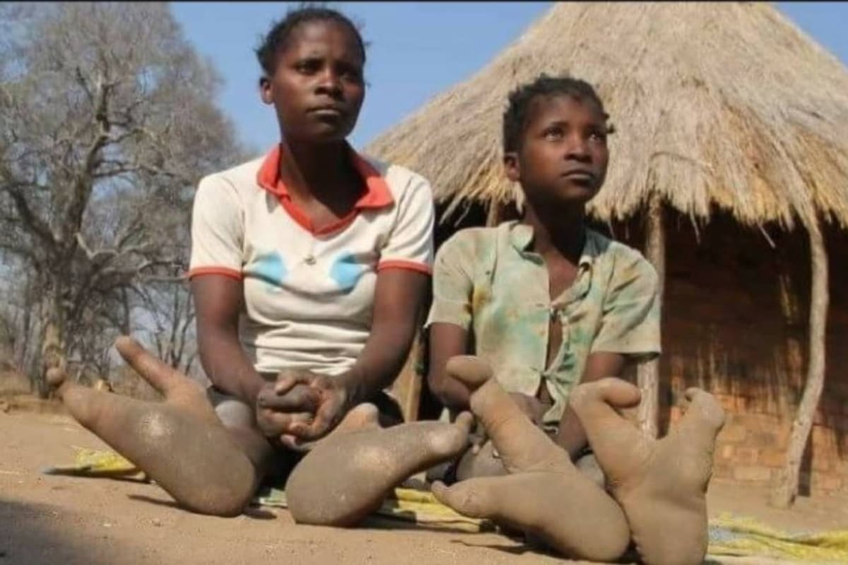 Algunos de los integrantes de la tribu Vadoma nacieron con esta extraña mutación en el gen número 7