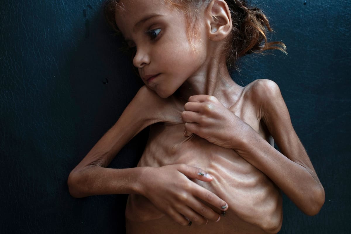 Amal Hussain, quien murió a los 7 años.