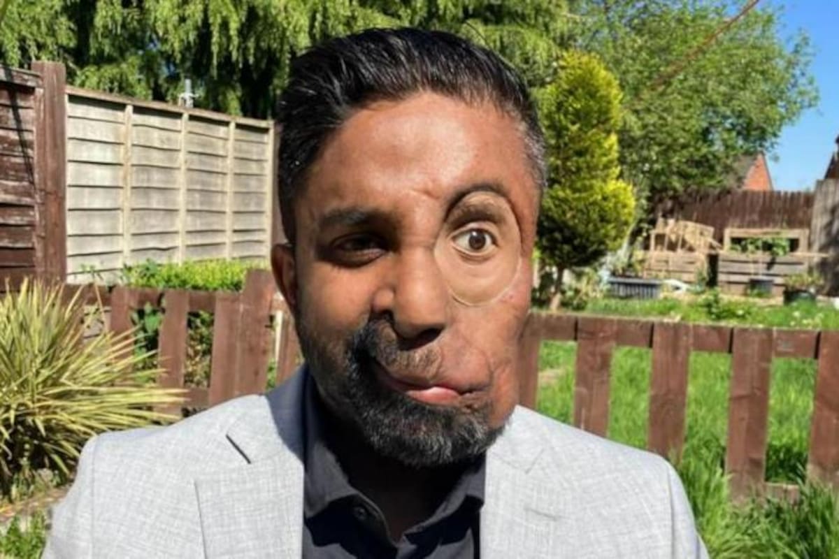 Amit Ghose nació con neurofibromatosis tipo 1, una condición que provoca el crecimiento de tumores benignos y ha desfigurado su rostro