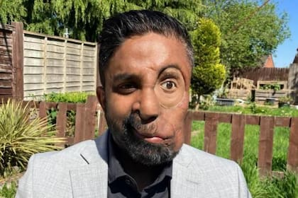 Amit Ghose nació con neurofibromatosis tipo 1, una condición que provoca el crecimiento de tumores benignos y ha desfigurado su rostro