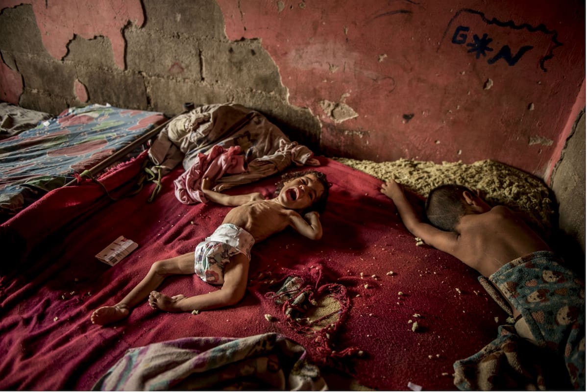 Anailin, de dos años, sufre de severa malnutrición y de una parálisis muscular tratable, pero el hospital más cercano esta vacío