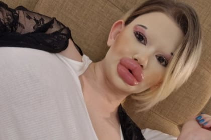 Andrea Ivanova recurrió a decenas de inyecciones de ácido hialurónico (Foto: Jam Press)