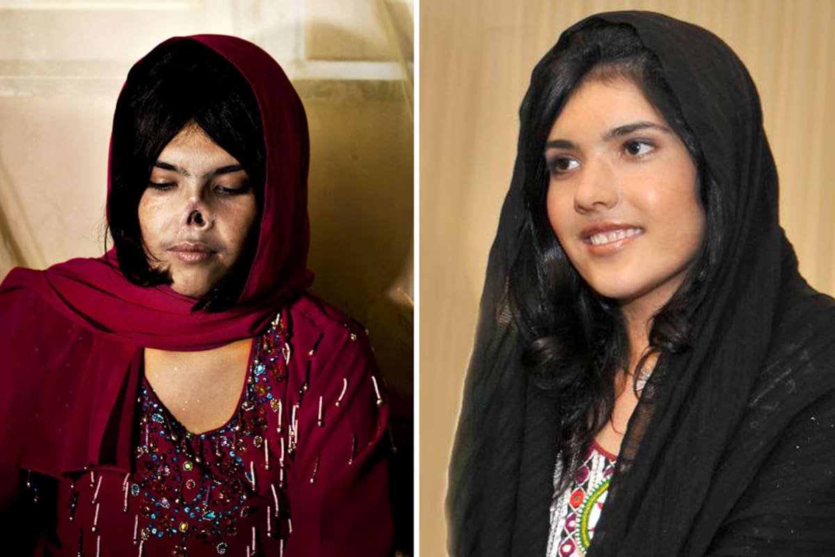 ANTES Y DESPUES. Aisha recuperó su rostro con una prótesis temporaria hasta ser sometida a una cirugía reconstructiva