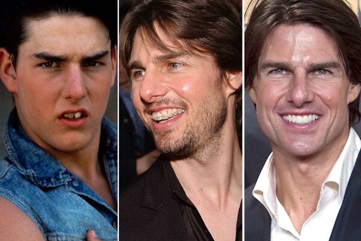 Antes y después: los dientes de Tom Cruise.