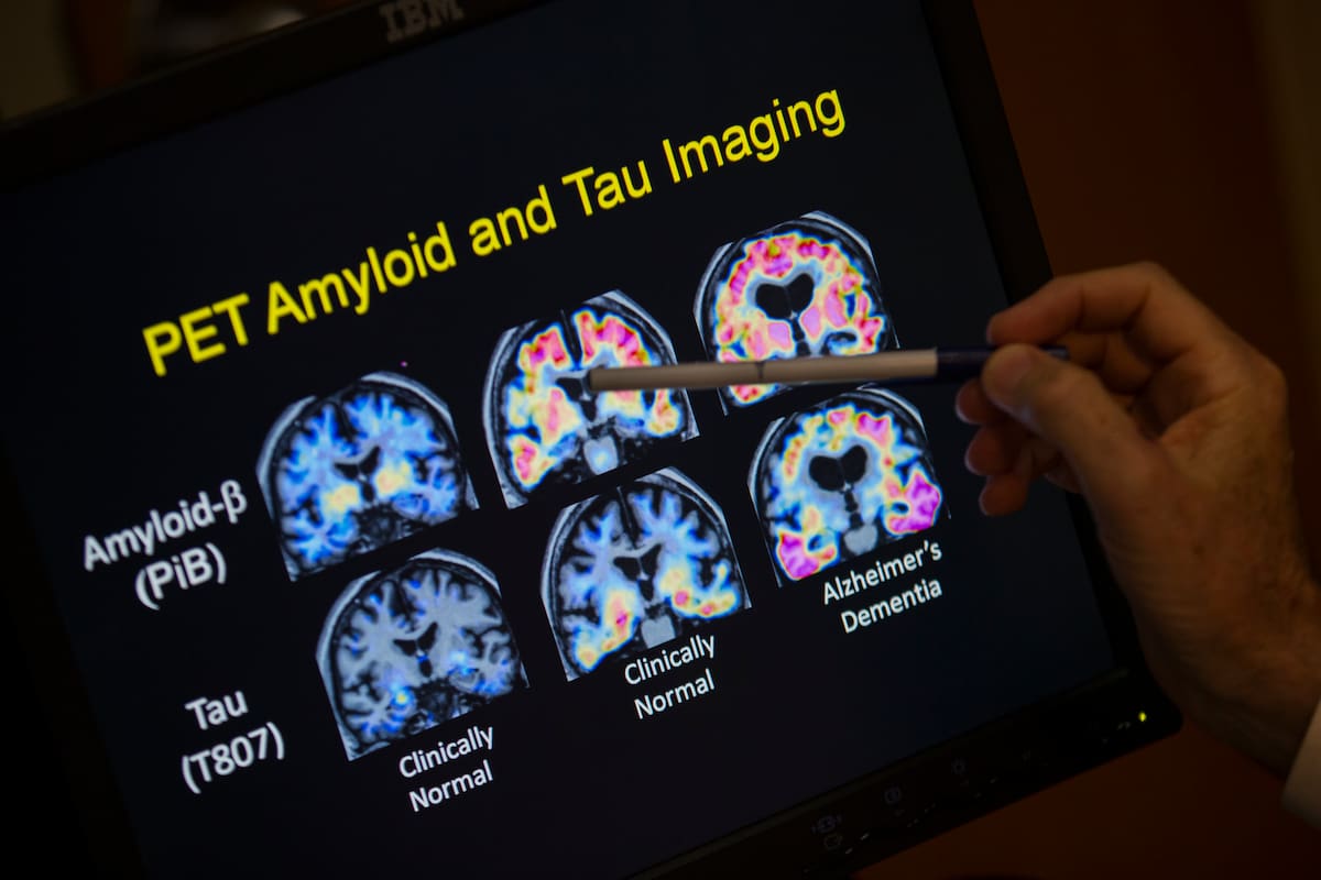 ARCHIVO - Un médico señala imágenes de un escáner cerebral dentro de un estudio sobre el Alzheimer en el hospital de la Universidad de Georgetown, el martes 19 de mayo de 2015 en Washington. (AP Foto/Evan Vucci, Achivo)