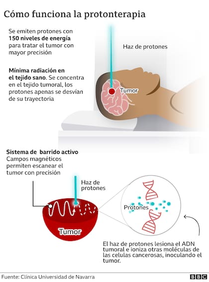 Así funciona la protonterapia