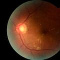 La IA del Conicet que revoluciona los controles oftalmológicos: detecta a tiempo daños visuales causados por la diabetes