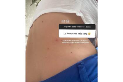 Así le quedó la panza a Celeste Cid tras la picadura de una araña
