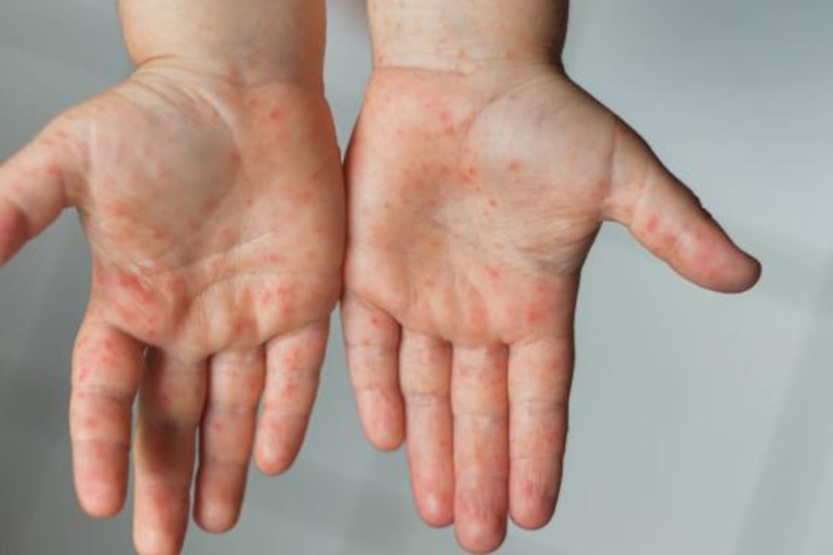 Así luce, en un principio, el sarpullido causado por la viruela del mono