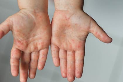 Así luce, en un principio, el sarpullido causado por la viruela del mono