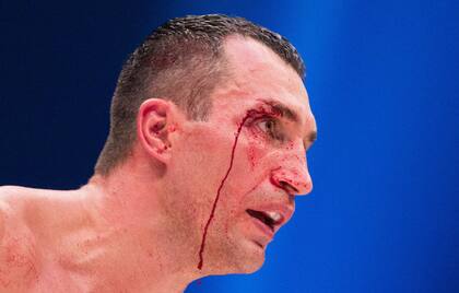 Así quedó el rostro de Klitschko tras le derrota