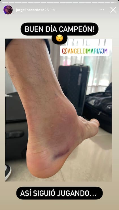 Así quedó el tobillo de Di María después de la final