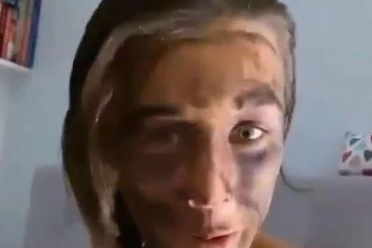 Así se mostró en una historia de Instagram: tiene negra gran parte de la cara