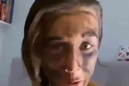 Así se mostró en una historia de Instagram: tiene negra gran parte de la cara