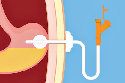 Así se realiza una gastrostomía