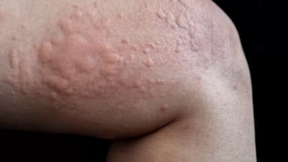 Así se ve la urticaria o la reacción alérgica a algo