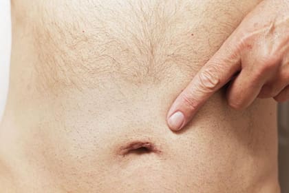 Así se ve un ombligo tras la realización de una operación por hernia umbilical