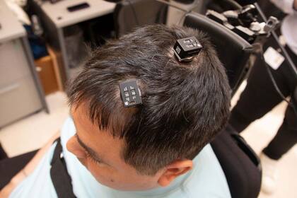 Así se ven los implantes neuronales con IA que le colocaron a Keith Thomas